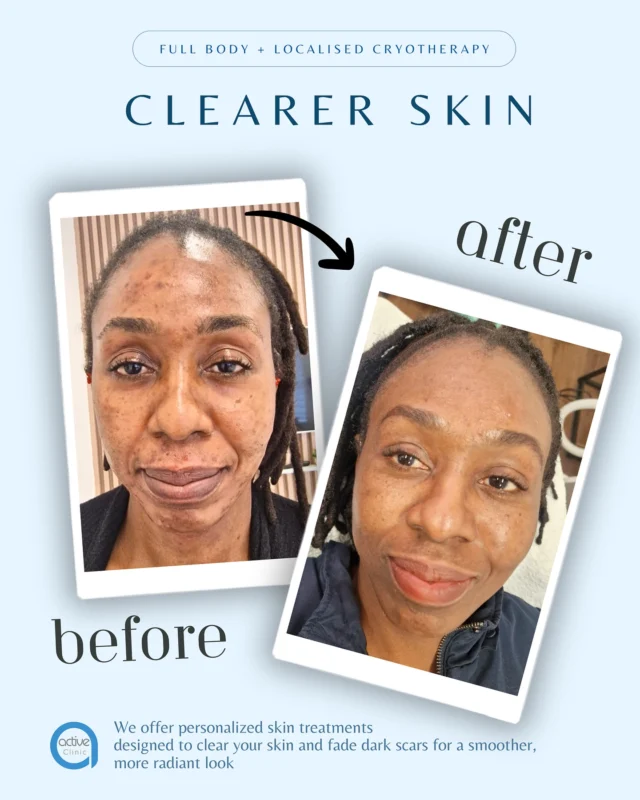 ✨ We’re all about giving your skin the love it deserves! Our personalised treatments are made just for you — to help fade dark spots, clear your skin, and bring out that natural glow. 💖🌿 💬 Book a consultation today and let’s find out what your skin really needs!

#SkinCareJourney #GlowingSkin #TSWSkinSupport #CustomSkinCare #SkinConfidence #SkinHealing #ClearSkinGoals #YouDeserveIt #HealthySkinVibes #activeclinicsuk