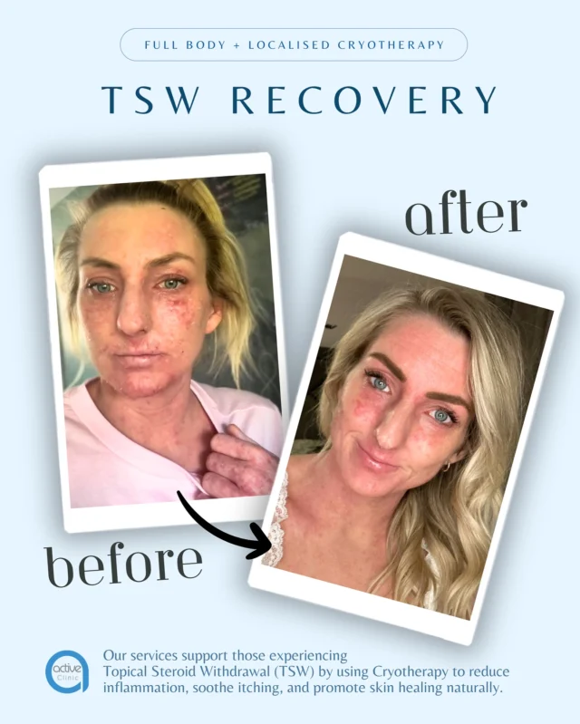Real healing. Real journey. 💙
Amy has been bravely sharing her battle with Topical Steroid Withdrawal (TSW) — and we’re honoured to be part of her healing process at Active Clinic through regular cryotherapy sessions ❄️
Get a glimpse of her progress — every step forward matters, and we’re here to support her every one of the way 💪✨
Healing isn’t overnight, but with care, consistency, and courage like Amy’s, it’s absolutely possible 💫

#TSWRecovery #CryotherapyHealing #ActiveClinic #HealingSkin #SkinJourney #RealSkinRealStories #InflammationRelief #TopicalSteroidWithdrawal #CryoForTSW