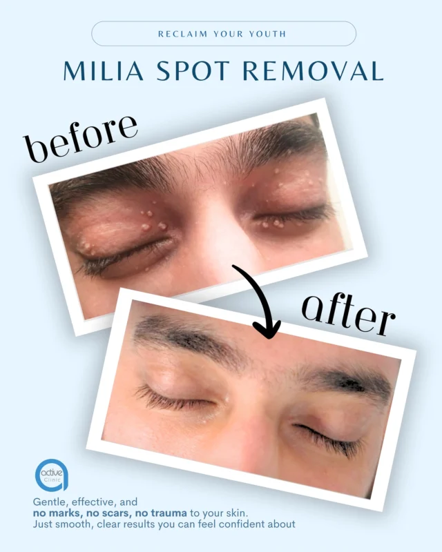 Say goodbye to stubborn milia the gentle way 💙

At Active Clinic, our Milia Removal Treatment is designed to safely and effectively clear milia without leaving behind any marks, scars, or skin trauma 😇

💙 Using precise techniques and expert care, we treat your skin with the attention it deserves — so you can enjoy a smooth, radiant complexion with confidence.
✔️ Non-invasive ✔️ Quick and comfortable ✔️ No downtime
📲 Book your consultation today and let your skin breathe freely again. 
#MiliaFree #ActiveClinicGlow #SkinConfidence #ClearSkinJourney #SkinHealthFirst #GentleSkincare #healthhack #biohack